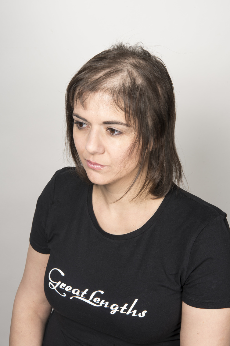 Haarteil für den Oberkopf – vorher